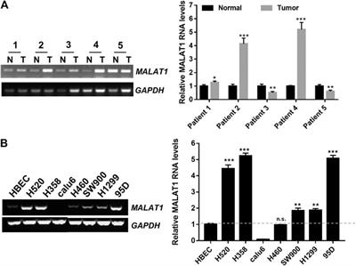 LncRNA MALAT1 Regulating Lung Carcinoma Progression via the miR-491-5p/UBE2C Axis